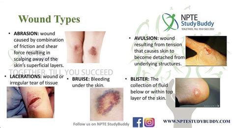 Types of wound | Doctor of physical therapy, Physical therapy student, Integumentary system