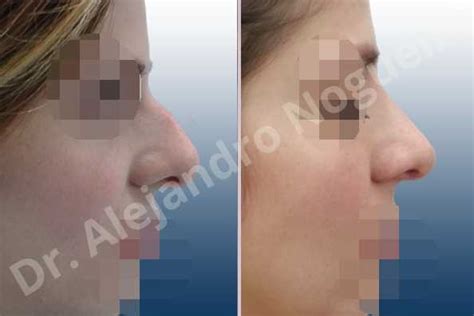 Rinoplastia Reductora Rinoplastia Estructural Rinoplastia Tnica