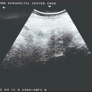 B Pre Surgical Scrotal Ultra Sound Scanning Demonstrating Multiple