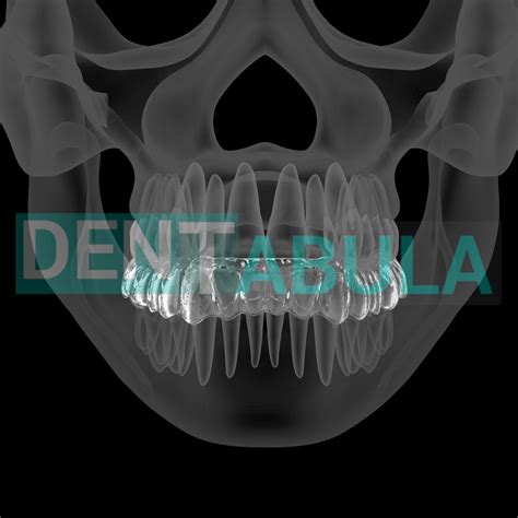 Каппа окклюзионная #стоматология #цифроваястоматология #smiledesign # ...