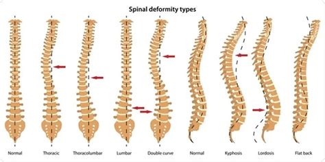 Spinal Deformities Houston Houston Spine Dr Martin