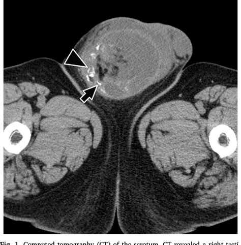 Figure 1 From Scrotal Abscess Mimicking As Intrascrotal Liposarcoma Semantic Scholar