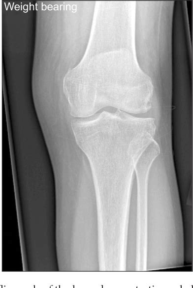 Knee Subchondral Stress Fracture