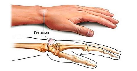 ГИГРОМА - Прием врача хирурга, клиника Центр Здоровой Кожи