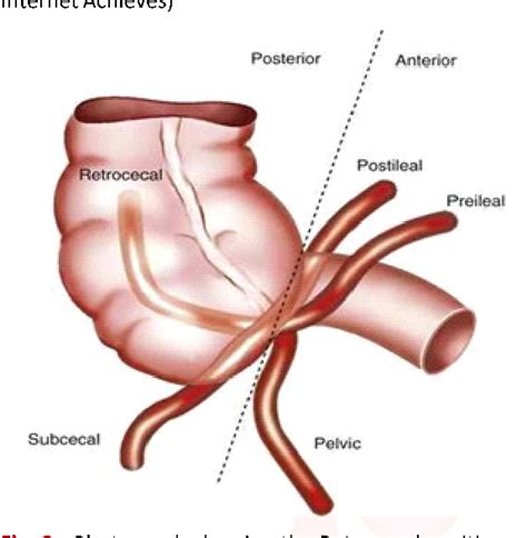 Figure From Prevalence Of Anatomical Variations Of The Position Of