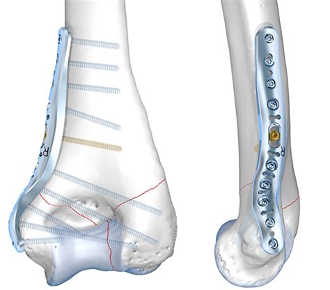 Distal Humerus System 2 8