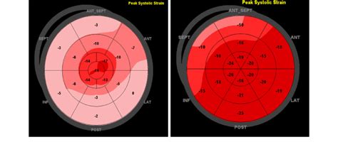 Global Longitudinal Strain Bulls Eye Map Global Longitudinal Strains