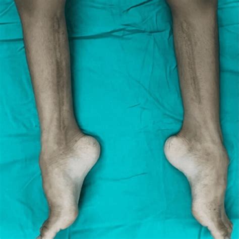 Post Operative Three Years Showing Static Equinus Contracture Of The