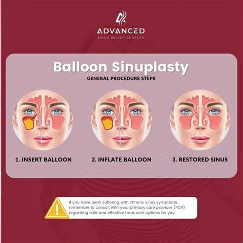 Everything You Need To Know About Balloon Sinuplasty Treatment Facts