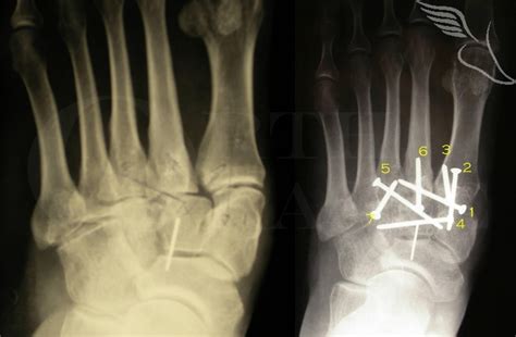 Lisfranc Fusion Orthoracle Luanmd