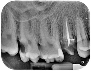 La Importancia Del Control Radiogr Fico Para Las Caries