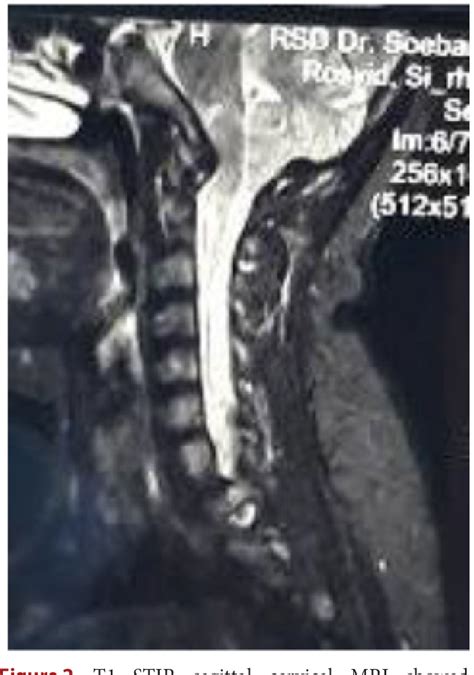 Figure 2 From Chiari Malformation Type 1 With Scoliosis A Case Report Semantic Scholar