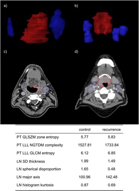 Example Of CT Images For Patient With Loco Regional Control A C And