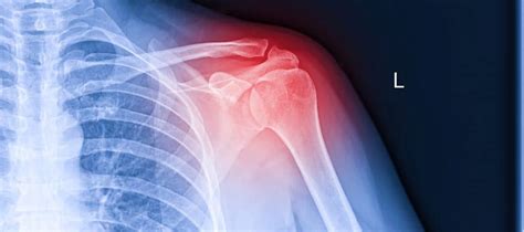 Shoulder Injections Injection Therapies Pain And Spine Specialists