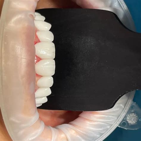 Dentech Lab🦷 Dentechlab • Instagram Photos And Videos