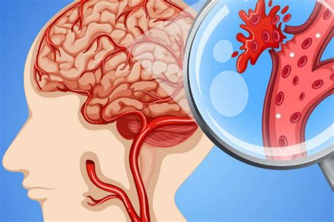 ¿cómo Identificar Los Síntomas De Un Accidente Cerebrovascular