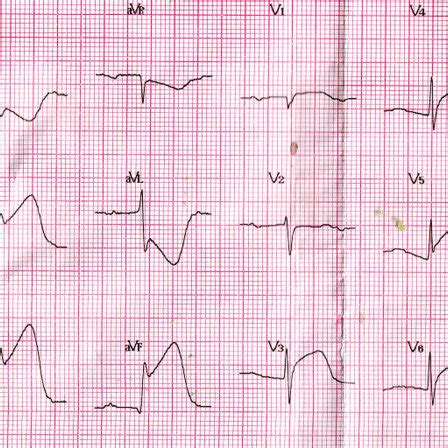 Initial Electrocardiogram Shown Is St Segment Elevation In The