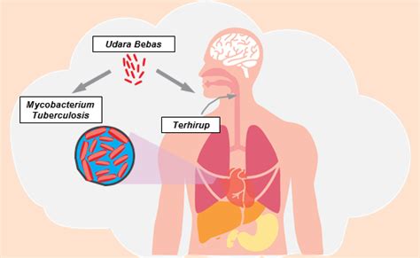 Hermina Hospitals Mengenal Penyakit Tuberkulosis