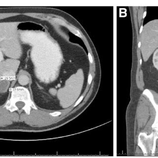 A One Month Follow Up Computed Tomography Scan The Right Adrenal Gland