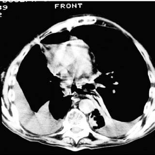 CT-scan 2 years later after exclusion. An area of left pleural ...