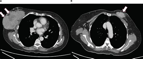 ct scan   thorax   breast mass arrowed  left breast