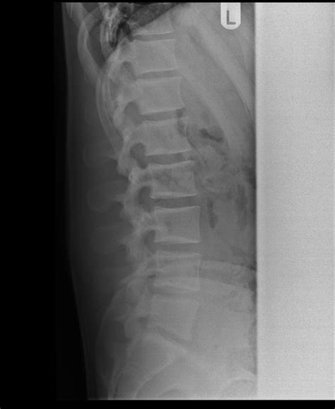 Radiographic Anatomy Of The Skeleton Lumbar Spine Lateral View Images