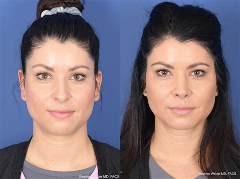 Rhinoplasty Before And After 10 Weber Facial Plastic Surgery