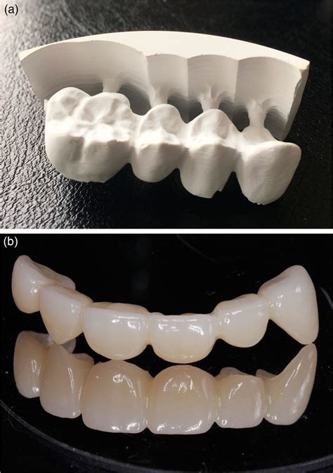 Zirconium Bridge