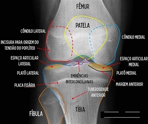 ArticulaciÓn De Rodilla