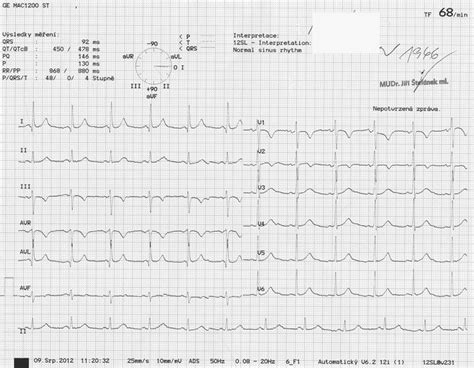 Ekg Z Praxe Medic Na Nemoci Studium Na Lf Uk