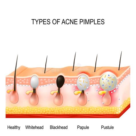 Types Of Acne Pimples Stock Vector Illustration Of Comedo 101722023