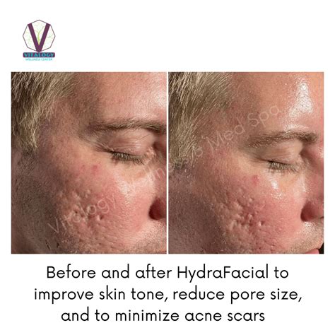 Hydrafacial Before After Vitalogy Wellness Med Spa