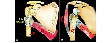 A To C Schematic Drawing Of The Latissimus Dorsi Ld Teres Major Tm