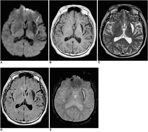 A Year Old Man With Chronic Intracerebral Hematoma Seen On Mr Images