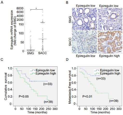 Expression Of Epiregulin Is Upregulated In Sacc And Is Correlated With