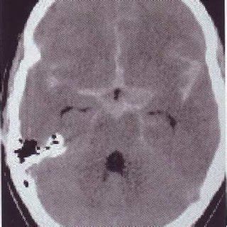 Ct Scan Of A Year Old Woman Presented With Headache And Vomiting