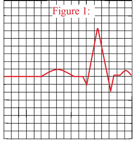 How to Measure a QRS Complex on an EKG Strip | QRS Complex Measurement Quiz