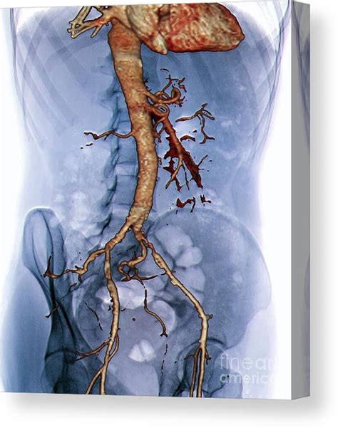 Abdominal Aorta 3d Ct Scan Canvas Print Canvas Art By Zephyr Pixels