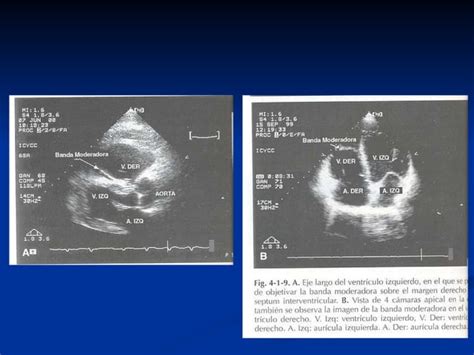 Cortes Ecocardiogr Ficos Ppt