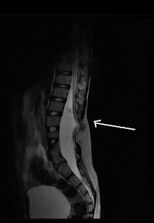 Lipomyelomeningocele-MRI - Sumer's Radiology Blog