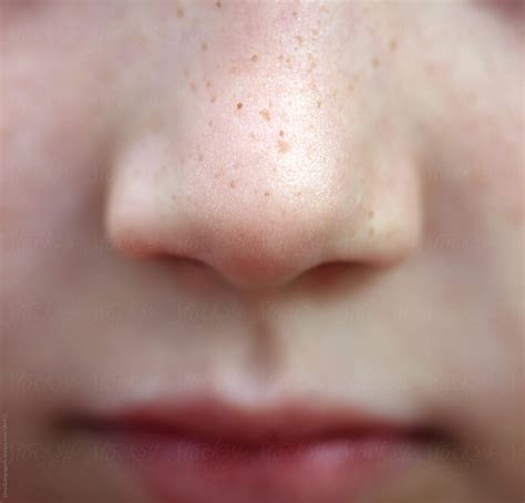 Nose Freckles