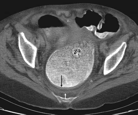 Stercoral Colitis Leading To Fatal Peritonitis Ct Findings Ajr