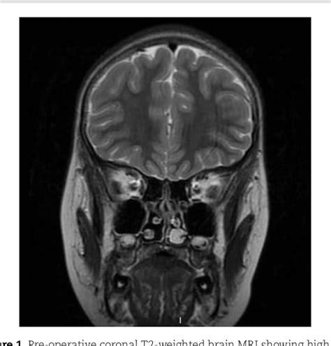 Figure From Pediatric Intranasal Lobular Capillary Hemangioma A Case