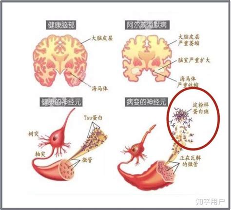 痴呆症 知乎