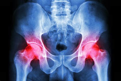 Femoroacetabular Impingement Syndrome Fai Enhance Physiotherapy