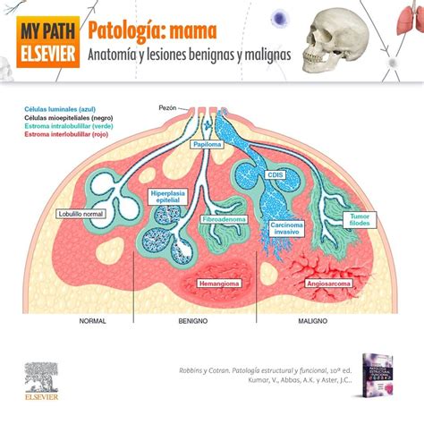 Patolog As Benignas Y Malignas De La Gl Ndula Mamaria Mind Map