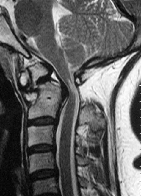 Spin Echo T Weighted Mri Images In Sagittal Plane In Neutral Position