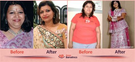 Before After Obesity Surgery In India