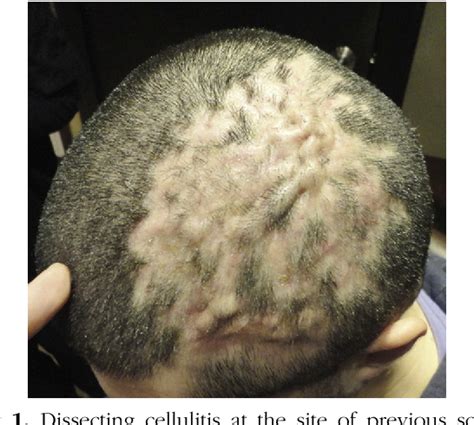 Figure 1 From Dissecting Cellulitis Dsc After Interferon Beta 1a Treatment And Scalp Trauma