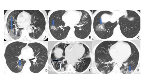 Scielo Brasil A Comparison Of Computerized Tomography Findings Of